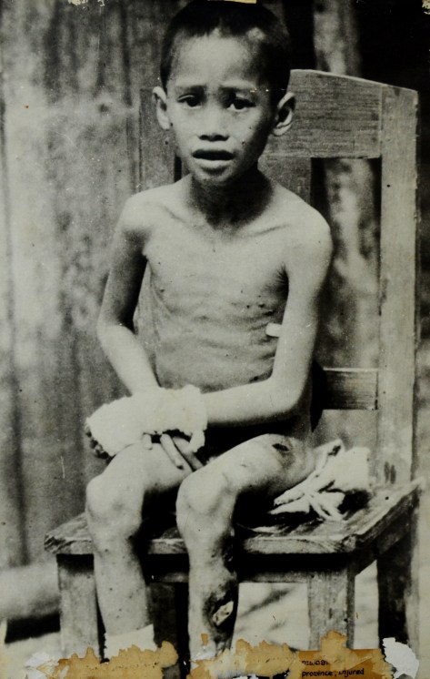 Thao Khamsing aged 7, citizen in Xieng Khouang province injured by US imperialist bomb.