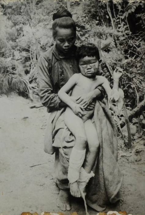Nang Phimpka injured by US imperialist napalm bombing